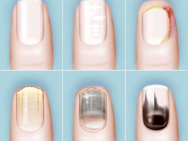 Če se vam to pojavi pod nohtom, je čas za ukrepanje